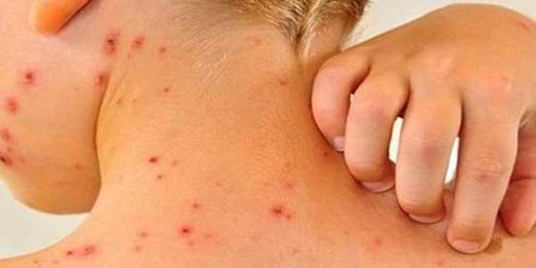 Менингоккокт халдвараас сэргийлэхийг зөвлөж байна
